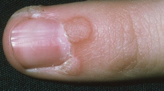 dermatologue spécialiste ongles